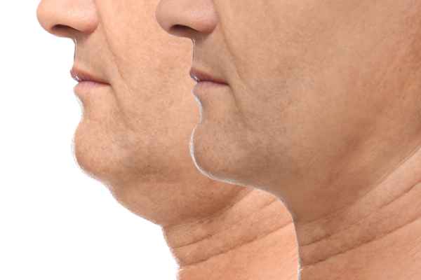 HIFU - Breakthrough in Anti - ageing 2 hifu results East Grinstead