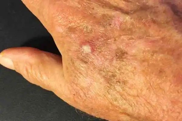 CryoPen for Actinic Keratoses 1 Image of Actinic keratoses East Grinstead on a person hand
